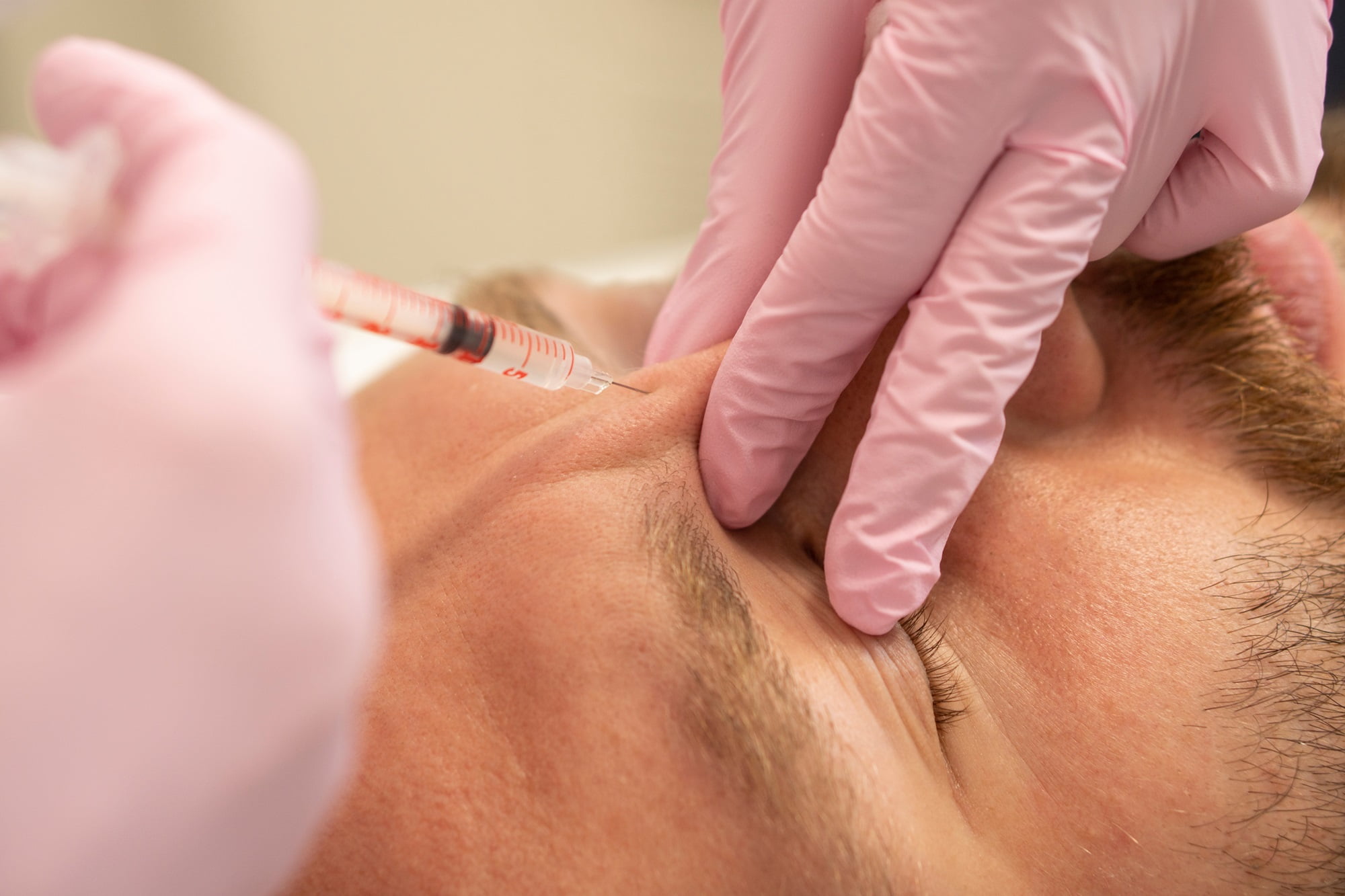 Men's cosmetology. Close up Cosmetologist makes a man the procedure of beauty injection of botulinum toxin in the wrinkles of the forehead and bridge of the nose rejuvenation of a handsome man